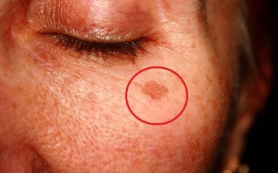 ¿Qué significa tener estas manchas en la cara y cómo eliminarlas? (1 / 2)