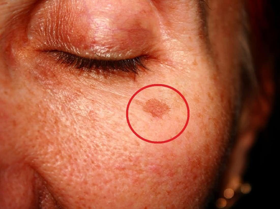 ¿Qué significa tener estas manchas en la cara y cómo eliminarlas? (1 / 2)