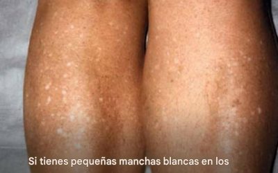 ¿Por qué me salen manchas blancas en la piel en verano y cómo puedo tratarlas? Responde un dermatólogo.