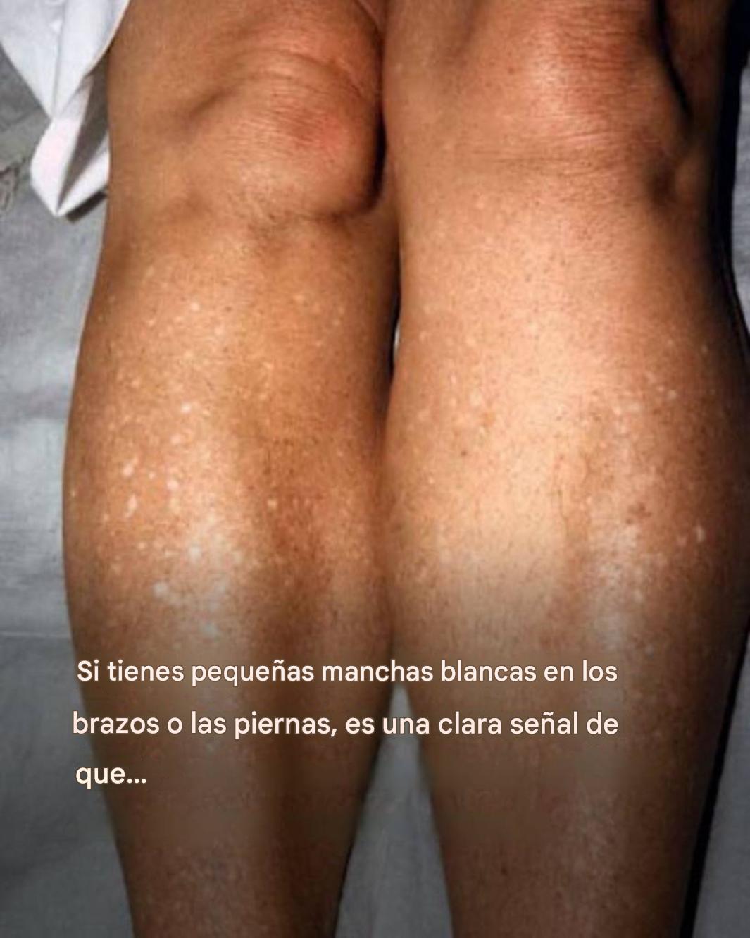 ¿Por qué me salen manchas blancas en la piel en verano y cómo puedo tratarlas? Responde un dermatólogo.