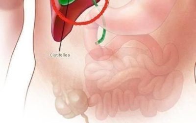 ¿Qué ocurre con el cuerpo después de la extirpación de la vesícula? 3 posibles enfermedades de seguimiento