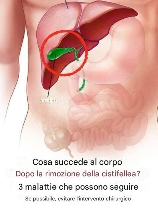 ¿Qué ocurre con el cuerpo después de la extirpación de la vesícula? 3 posibles enfermedades de seguimiento