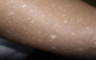 Pequeñas manchas blancas en brazos y piernas: lo que necesitas saber