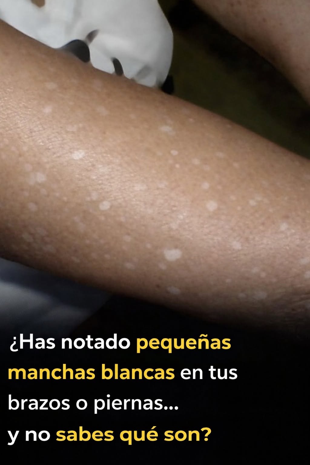 Pequeñas manchas blancas en brazos y piernas: lo que necesitas saber